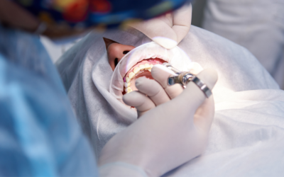 Do You Need a Bone Graft Before Getting a Dental Implant?