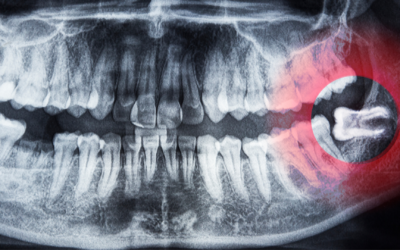 How Long Does Wisdom Teeth Removal Recovery Take?