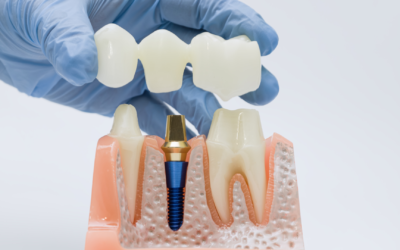 How Much Do Dental Implants Cost in Star, Idaho?