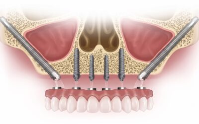 What Are Zygomatic Implants and Who Needs Them?