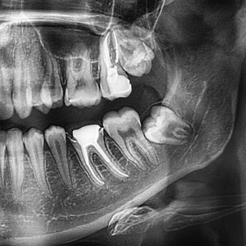 Wisdom Teeth Removal in Star ID