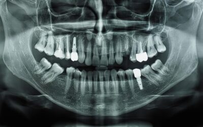 How Long It Takes to Recover From Dental Implant Surgery
