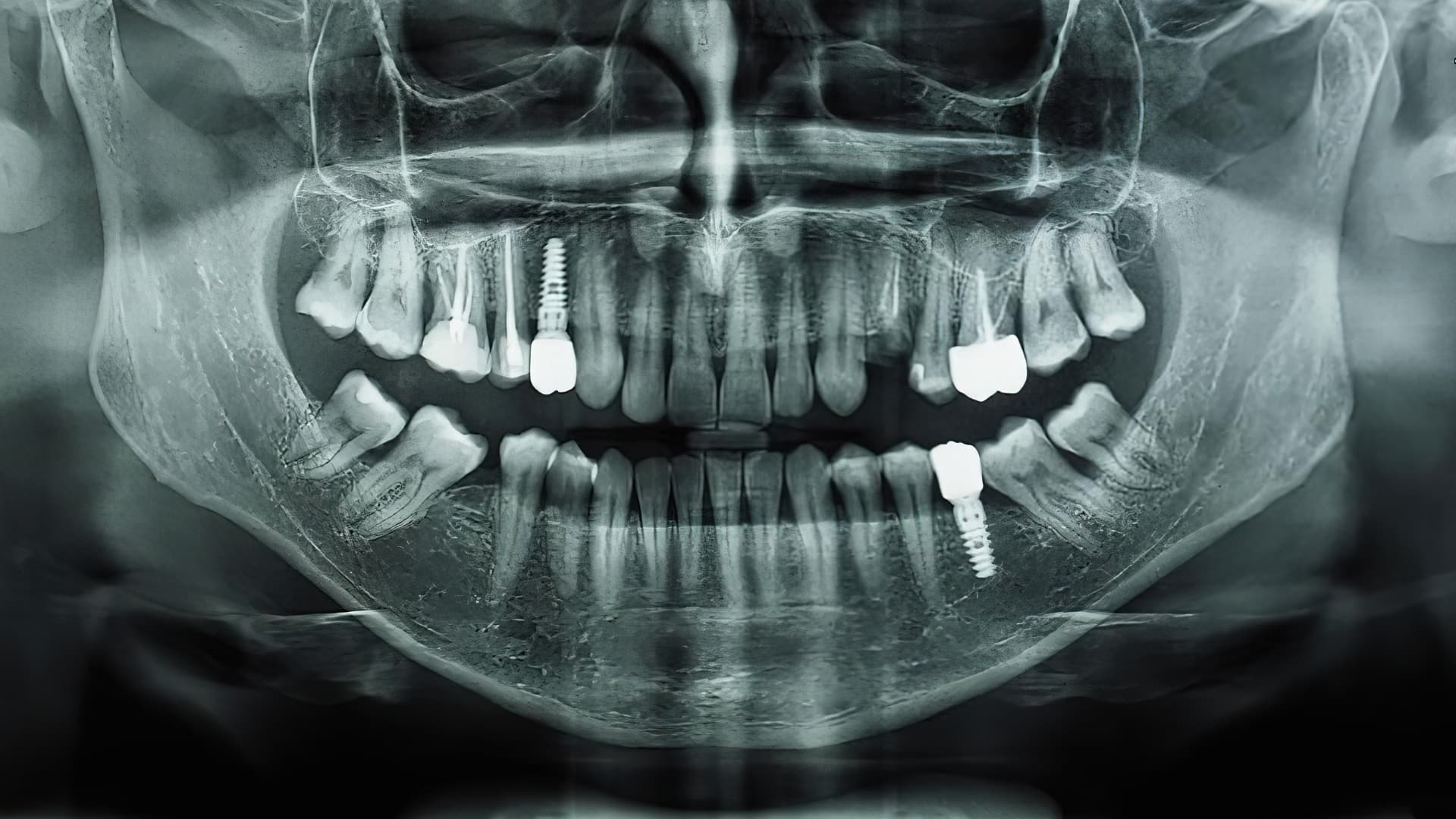 X-ray of a mouth with dental implants in place after implant surgery