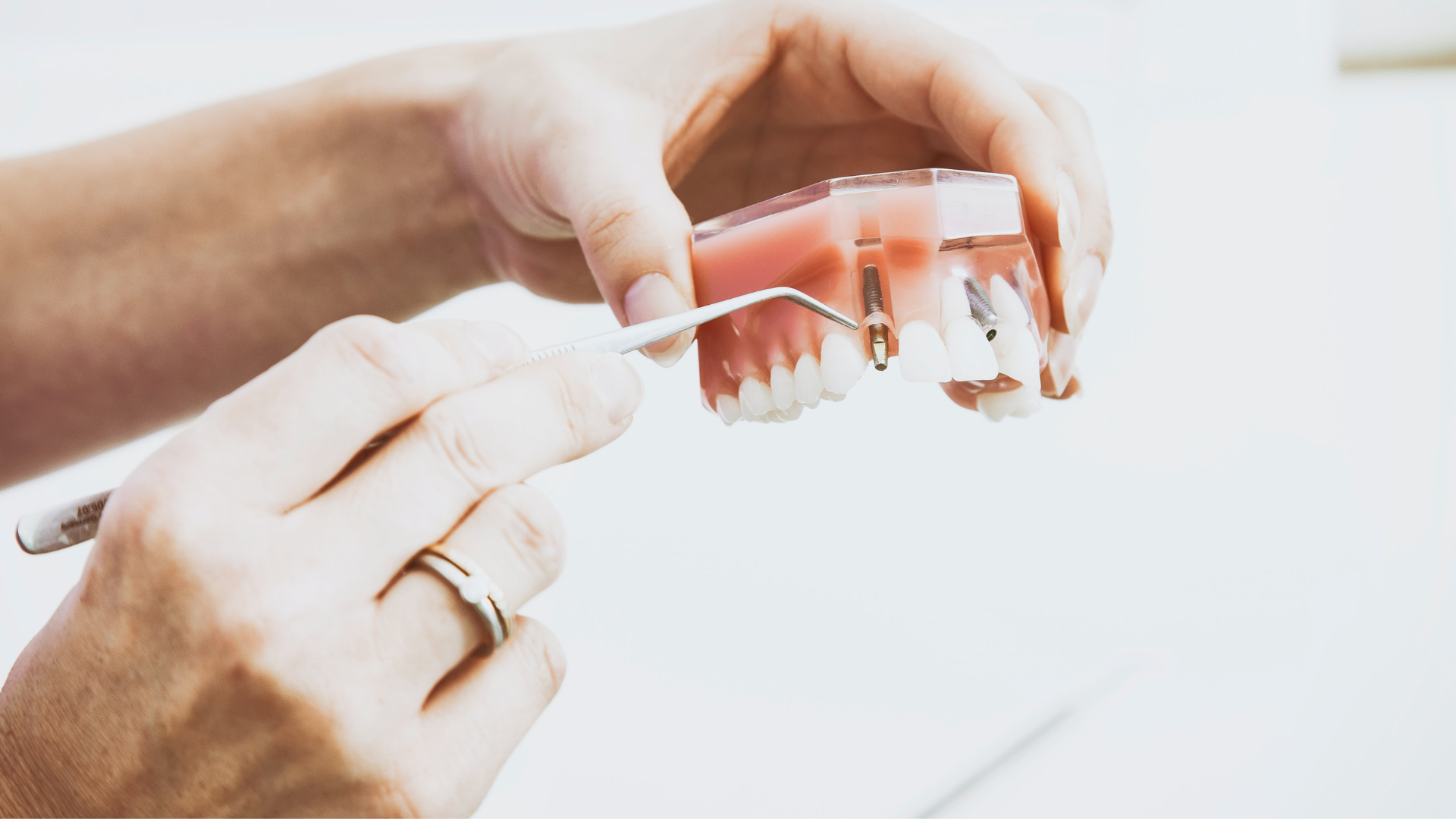 dental implant procedure